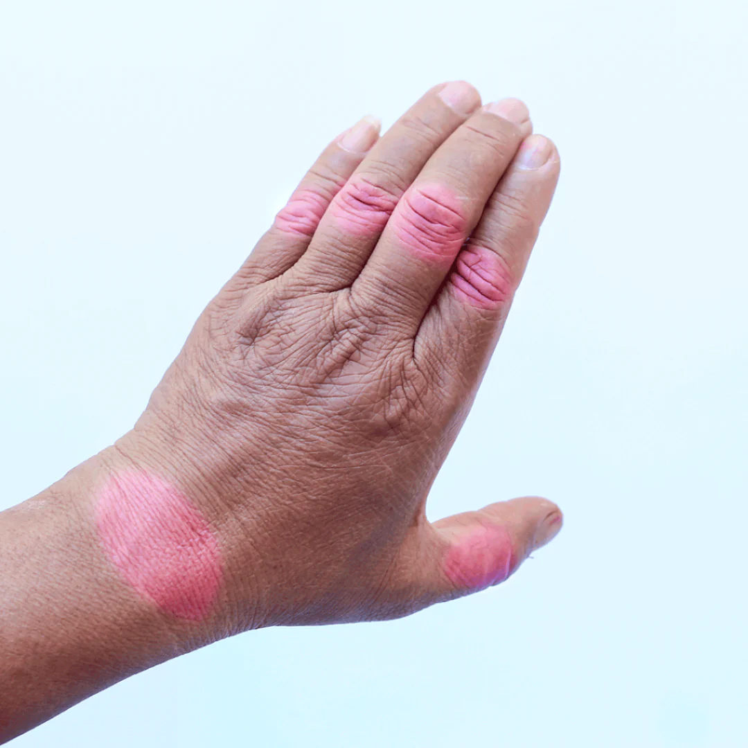 Fibromialgia /Artritis