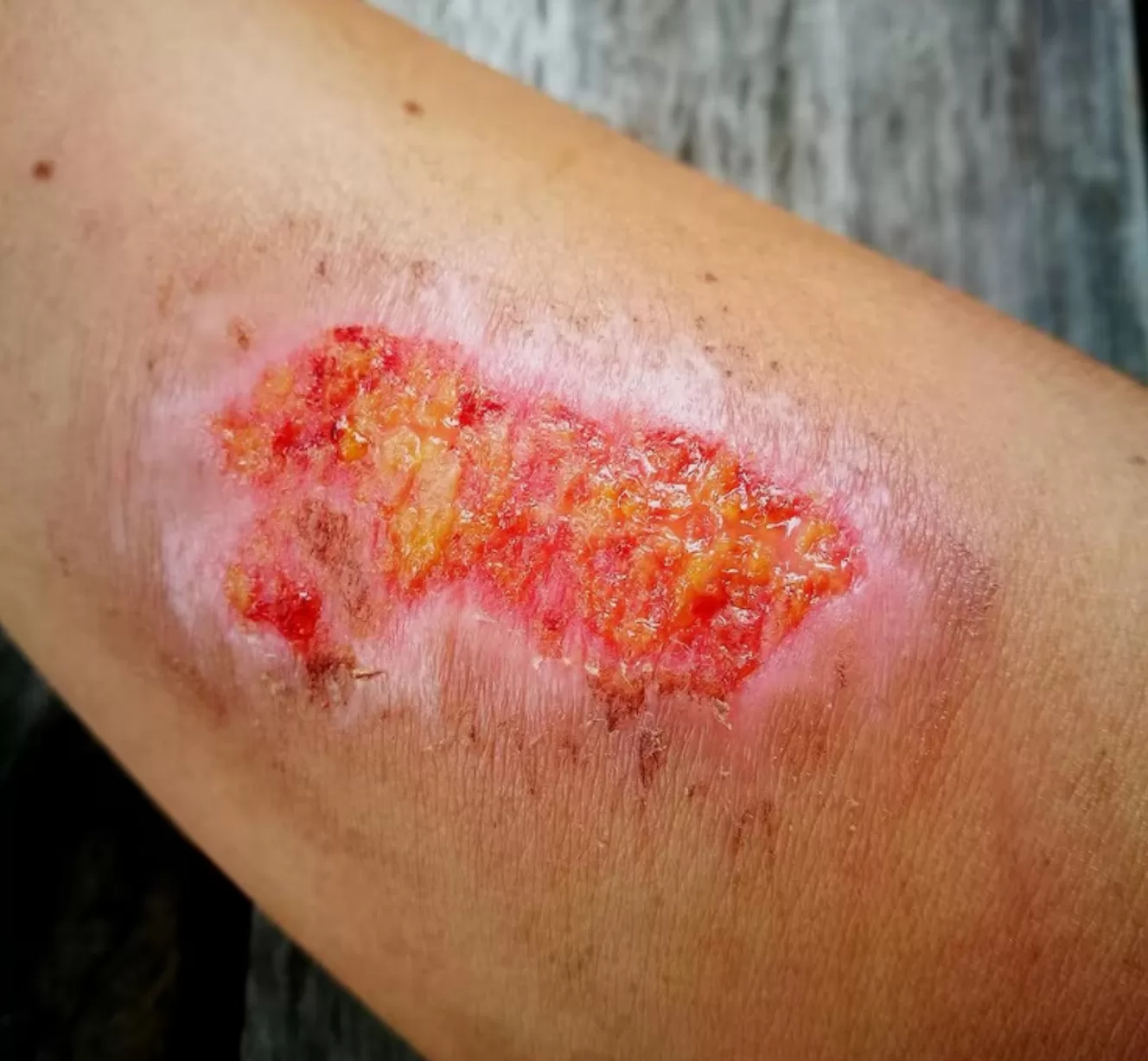 Heridas infectadas